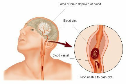 Photo of a stroke situation.